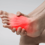 Neuromas