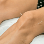 Dry Needling